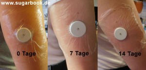 FreeStyle Libre Sensor unter Duschpflaster